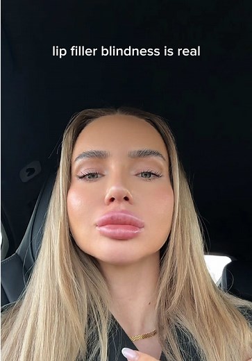 Lip Filler Fails & Botched Treatments