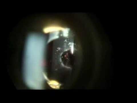 Yag Capsulotomy- for "after cataract" lens capsule clouding
