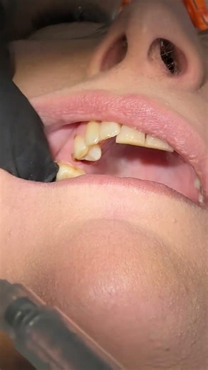 Anaesthesia for extraction if upper premolar #oralsurgery #extractions #teaching #dentalschool #den