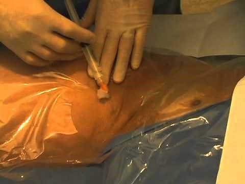 Placement of a Femoral Venous Catheter mdash NEJM