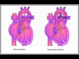Heart Sounds:Patent Ductus Arteriosus