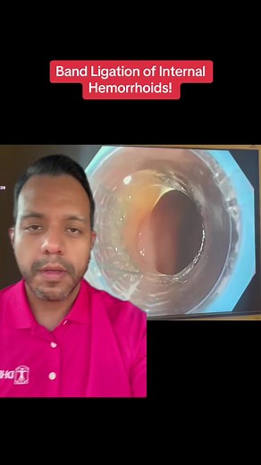 When preparation H, fiber supplements, steroid creams, and stool softeners aren’t helping, endoscopic band ligation is a good option for management of symptomatic internal hemorrhoids 💪🏽 #fyp #hemorrhoids #internalhemorrhoids #colonoscopy #gastroenterology #tiktokdoc