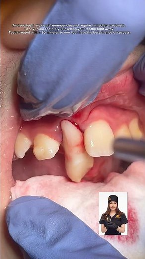 Avulsed Tooth can be replanted Immediately