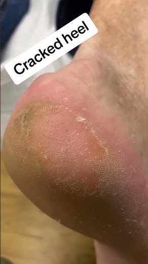 Satisfying Cracked Heel Callus Removal by Podiatrist | Scalpel Foot Transformation