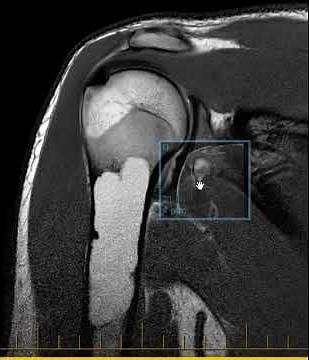 Unicameral bone cyst humerus in 18 year old #simplebonecyst