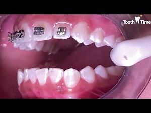 How they put braces on - 13 years old patient - Tooth Time Family Dentistry New Braunfels Texas