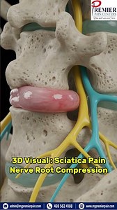 What Causes Sciatica? 3D Animation Explains #sciatica #herniateddisc