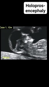 1.7K reactions · 260 shares | Holoprosencephaly #Radiology #Ultrasound #MedicalImaging #FetalUltrasound #ObstetricUltrasound #PrenatalUltrasound #Sonography #DiagnosticImaging #FetalAnomalyScan #PrenatalScreening #ObstetricRadiology #FetalMedicine #MaternalFetalHealth #EarlyPregnancyScan #Radiologist #Sonographer #MedicalDiagnosis #OBGYN #PerinatalCare #HighRiskPregnancy #MaternalHealth | Radiology Interesting Cases | Facebook