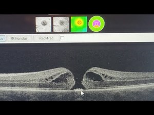 Macular Hole Surgery update video#2-Scar tissue, floaters. cataracts. My journey to regain my sight.