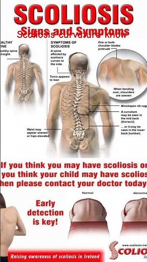 Scoliosis Spine Deformity Explained | Causes, Symptoms & Physiotherapy Treatment