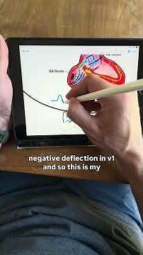 Left Atrial Enlargement