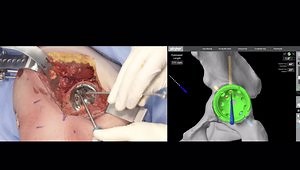 Reimagining Revision Hips: Mako Total Hip Posterior Lateral Approach
