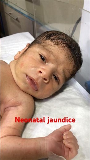 Neonatal jaundice treatment in nicu blue light therapy