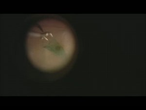 Macular Hole Repair - Eyetube