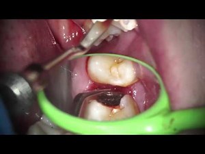 GingiBurs Gingivectomy • Video • MEDtube.net
