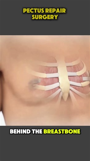 How Pectus Excavatum Repair Surgery Is Done | Step-by-Step Surgical Procedure #PectusExcavatum