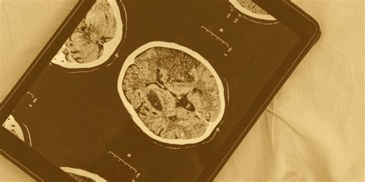 Prompt TBI Treatment Reduces Alzheimer's Risk by up to 41% | Neuroscience