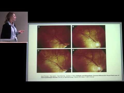Transient Monocular Vision Loss