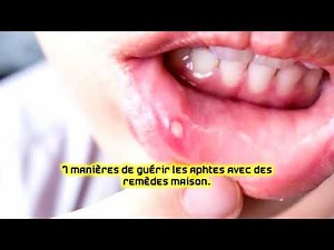 7 manières de guérir les aphtes avec des remèdes maison