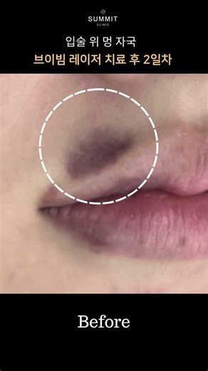Summit Clinic – V-beam Laser Treatment for Bruise Reduction in Just 2 Days
