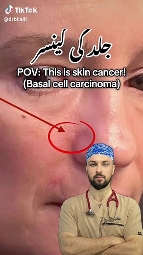 Understanding Basal Cell Carcinoma: Symptoms and Treatment
