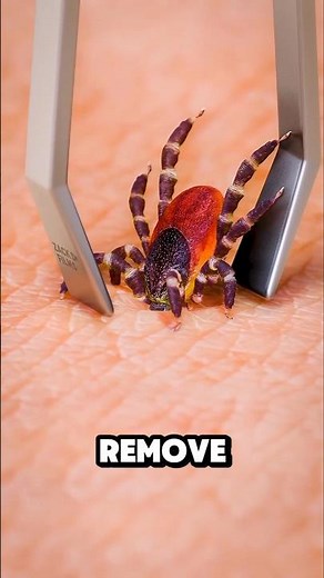 Why You Should NEVER Yank a Tick 😬