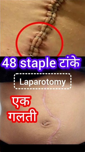 Laparoscopic vs Laparotomy surgery