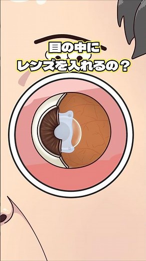 目の中にレンズを入れるの？
