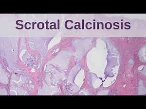 Scrotal Calcinosis - Pathology mini tutorial