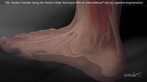 FDL Tendon Transfer Using Tension-Slide Technique and InternalBrace™ Spring Ligament Augmentation