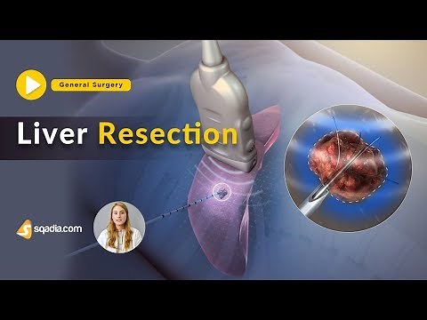Liver Resection | Segmental and Local | Surgical Anatomy and Procedures | TRAILER