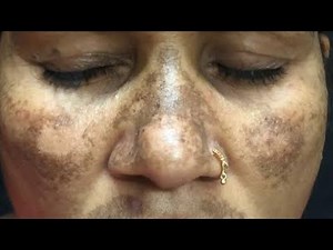 Treatment of Stubborn Melasma or Resistant Melasma | Kayakalp Laser Clinic
