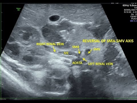 Intestinal Malrotation with Midgut Volvulus in Newborn - Ultrasound