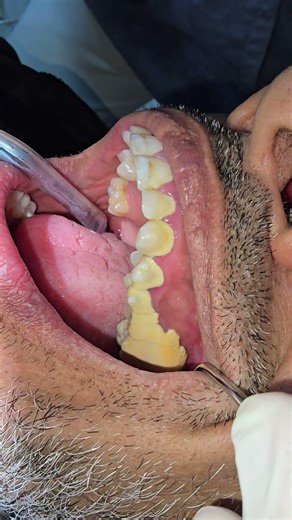 أكبر كمية تكلسات وجير الأسنان يمكن أن تراها #calcus #tartar #dentist