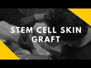 Stem Cell Skin Graft Treatment