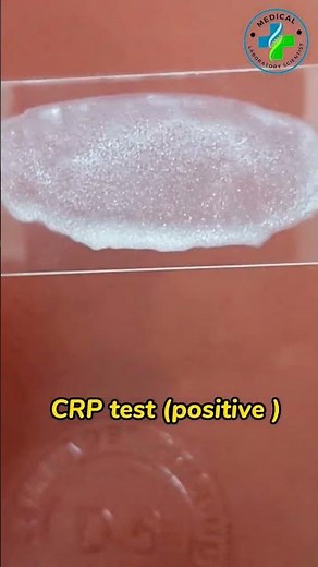 CRP test | what is CRP | C reactive protein test | CRP latex test|CRP qualitative test|CRP positive