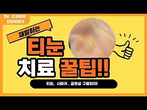 티눈 치료와 예방에 대한 꿀팁!!