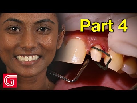 HOW TO Deliver Zirconia Crowns on ANTERIOR Teeth