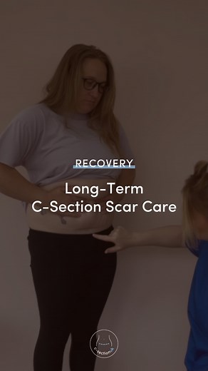 ad| Longer term scar care for C-Section mums is not talked about enough. And beyond 6 weeks it’s barely even recognised as a thing but we are on a mission to change that. Let’s talk about one of the many secret sauces to a good recovery. Medical grade silicone has been shown to reduce redness and flatten scars. It works by hydrating the scar and reducing the production of collagen fibres. The research suggests that the protective barrier over the scar allows the scar itself to recover and heal. 