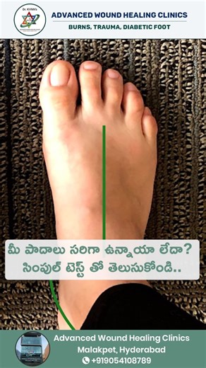 Santosh Murthy on Instagram: "🔥 Is Your Foot Posture Normal? Flat? Or High-Arched? Understanding your foot posture is the first step toward preventing pain, improving balance, and protecting your long-term foot health. The way you stand affects everything—from pressure distribution to joint alignment and overall mobility. In this reel, Dr. Hrishikesh breaks down the simple cues that help you identify whether your foot posture is normal or showing signs of flat foot or high arch. A quick self-ch