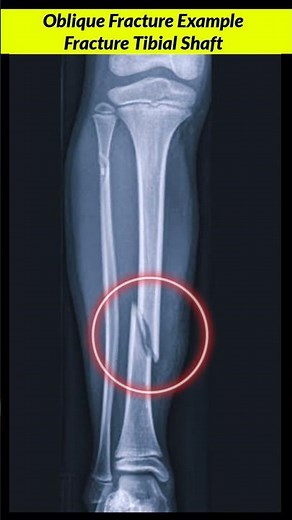 Oblique Fracture ? X-ray Leg #xray #fracture #radiographerusn