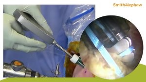 Knotless Arthroscopy Hip Labral Repair and Capsular Plication with: REGENETEN◊ Implant Augmentation