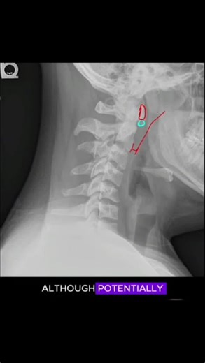Cervical Spine X-ray Interpretation #radiology #anatomy