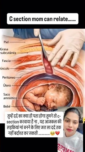 दर्द से बचने के लिए c-section करवाया है.. #shorts #ytshorts
