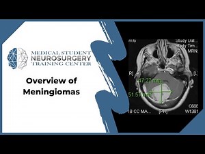 Overview of Meningiomas