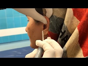 Removal of a bug from the ear brings relief to the patient