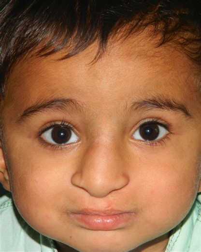 Free Cleft Lip and Cleft Palate Surgery In Lahore By Dr Irfan Ishaq Smile Home Trust "Smile Makers." We are providing free Cleft Lip & Palate Surgery. We have best Plastic Surgeons in Our Team. ہم کٹے ہونٹ اور تالو کی مفت اور بہترین سرجری فراہم کرتے ہیں۔ سمائل ہوم کی ٹیم میں پاکستان کے بہترین پلاسٹک سرجن موجود ہیں۔ Dr Irfan Ishaq MBBS FCPS FACS (USA) Plastic and Aesthetic Surgeon Lahore , Pakistan ☎️ 92 307 4666888 Free Cleft Lip and Cleft Palate Surgeries #cleftlip #cleftpalate #cleftstrong #cl