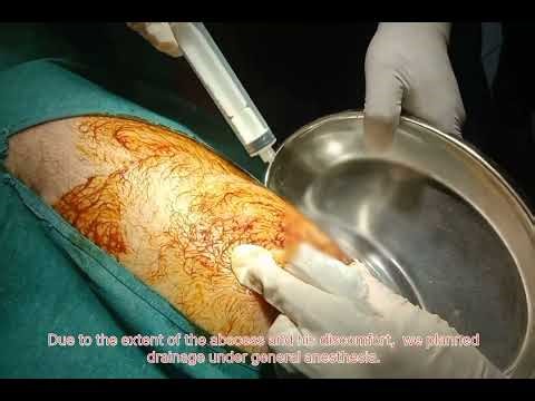 Injection site abscess