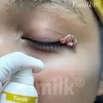 🌟 Tired of warts or skin tags? Skip the pricey clinic and try BBOJI® WartErase Cryo Freeze Spray — fast, precise, at-home cryo care that helps unwanted spots dry out and fall away naturally. 🔥 -55°C precision freeze 🔥 Gentle on skin 🔥 Up to 60% OFF — limited stock! 👉 Tap to get smooth, clear skin today! 👉https://www.sunzmiah.com/products/bboji®-warterase-cryo-freeze-spray | Professor Daniel Morgan