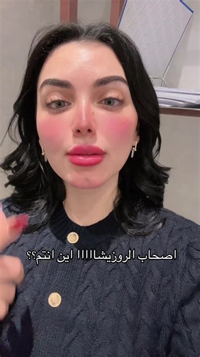 روزيشة وحرارة الوجه: كيف تعالجين الأمر؟